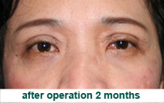 plastic-surgery-blepharoplasty